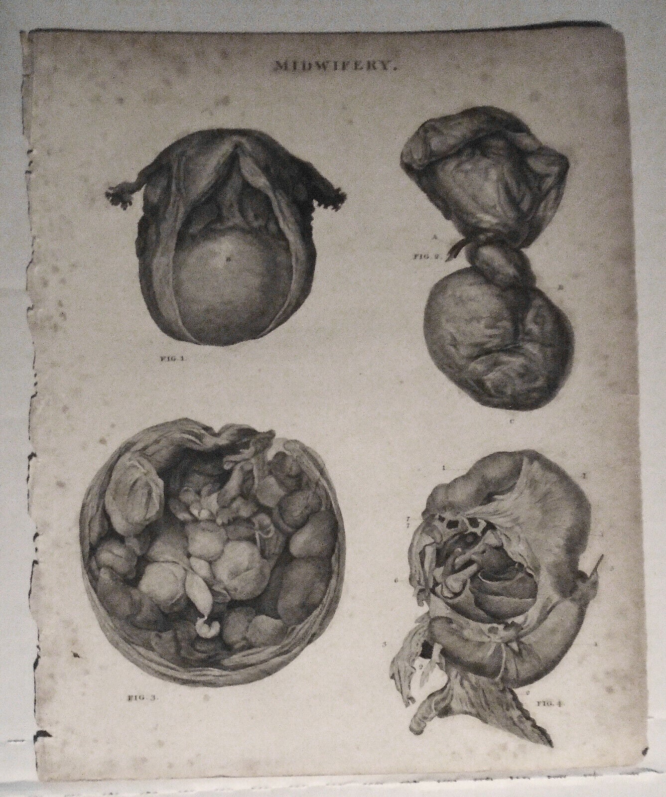 MIDWIFERY - engraved plate from Rees' Cyclopaedia, published 1802-1820