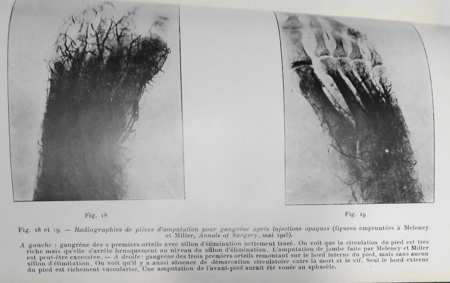 1928 - Etude Chirurgicale Des Gangrenes Juveniles ... by Raymond Leibovici, Dr.