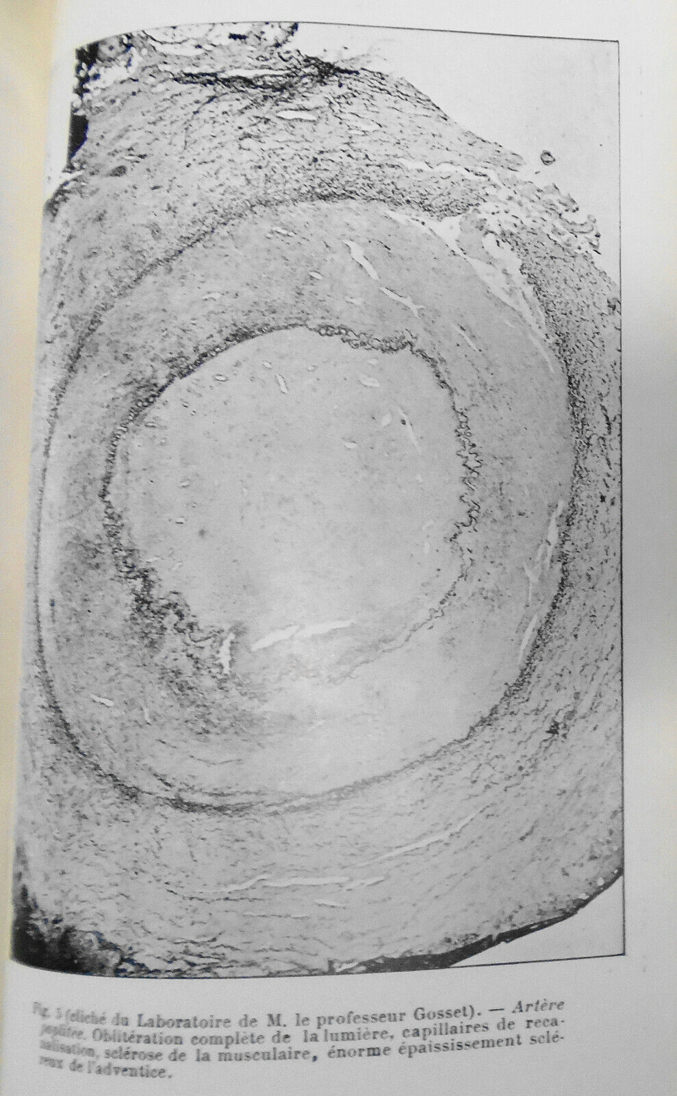 1928 - Etude Chirurgicale Des Gangrenes Juveniles ... by Raymond Leibovici, Dr.