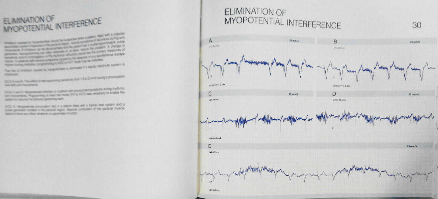 Pacemaker electrocardiograms : an introduction to practical analysis - SIGNED