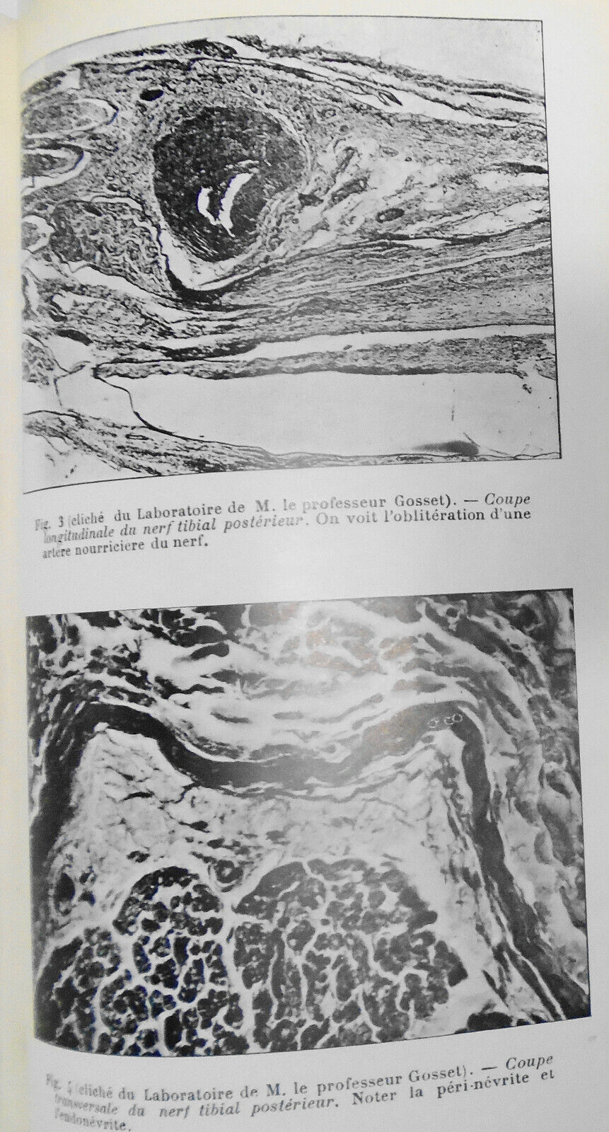 1928 - Etude Chirurgicale Des Gangrenes Juveniles ... by Raymond Leibovici, Dr.