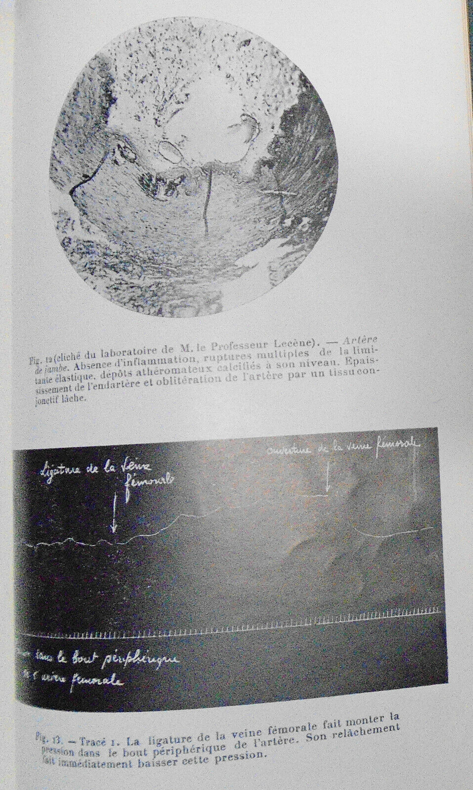 1928 - Etude Chirurgicale Des Gangrenes Juveniles ... by Raymond Leibovici, Dr.