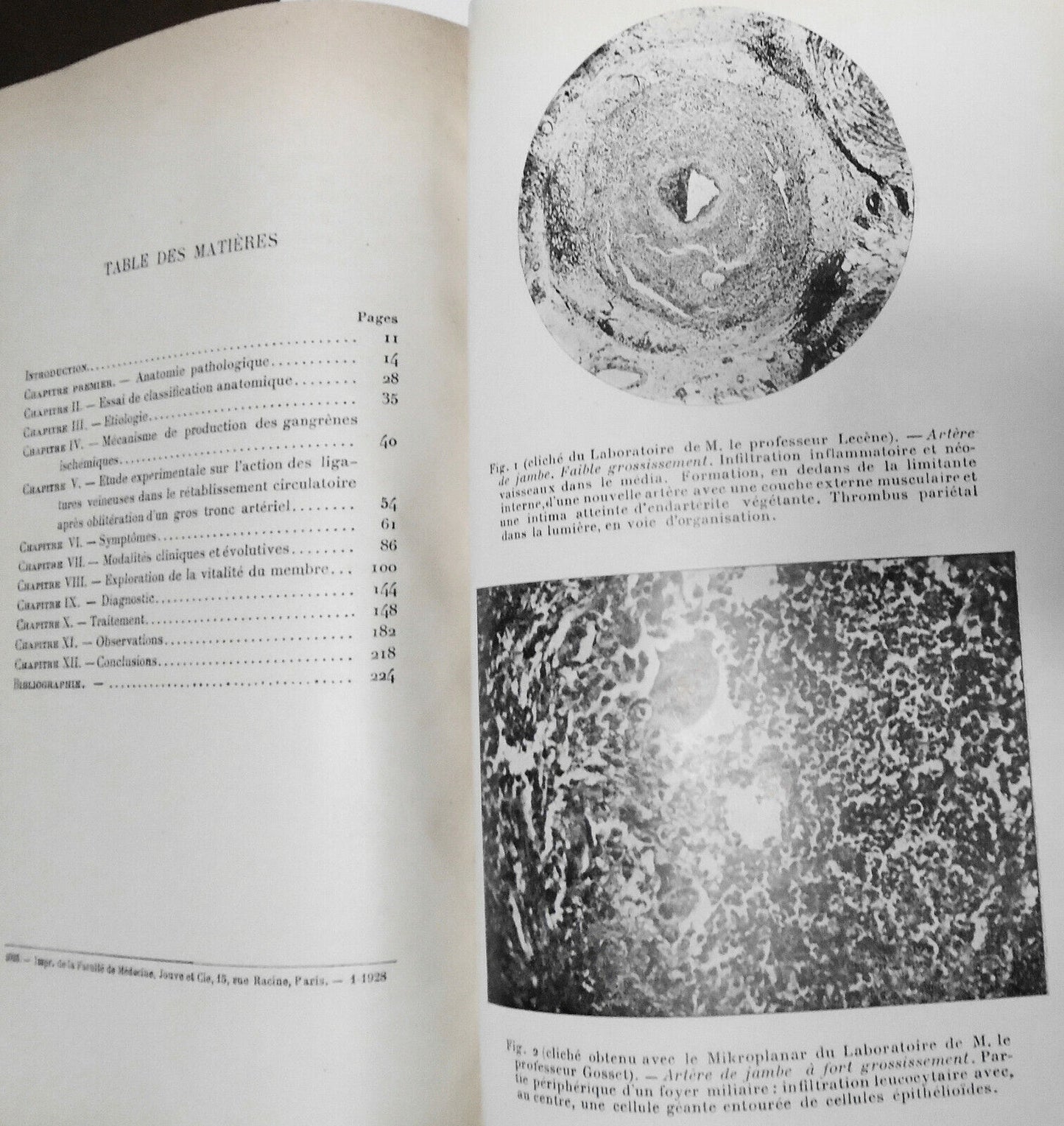 1928 - Etude Chirurgicale Des Gangrenes Juveniles ... by Raymond Leibovici, Dr.