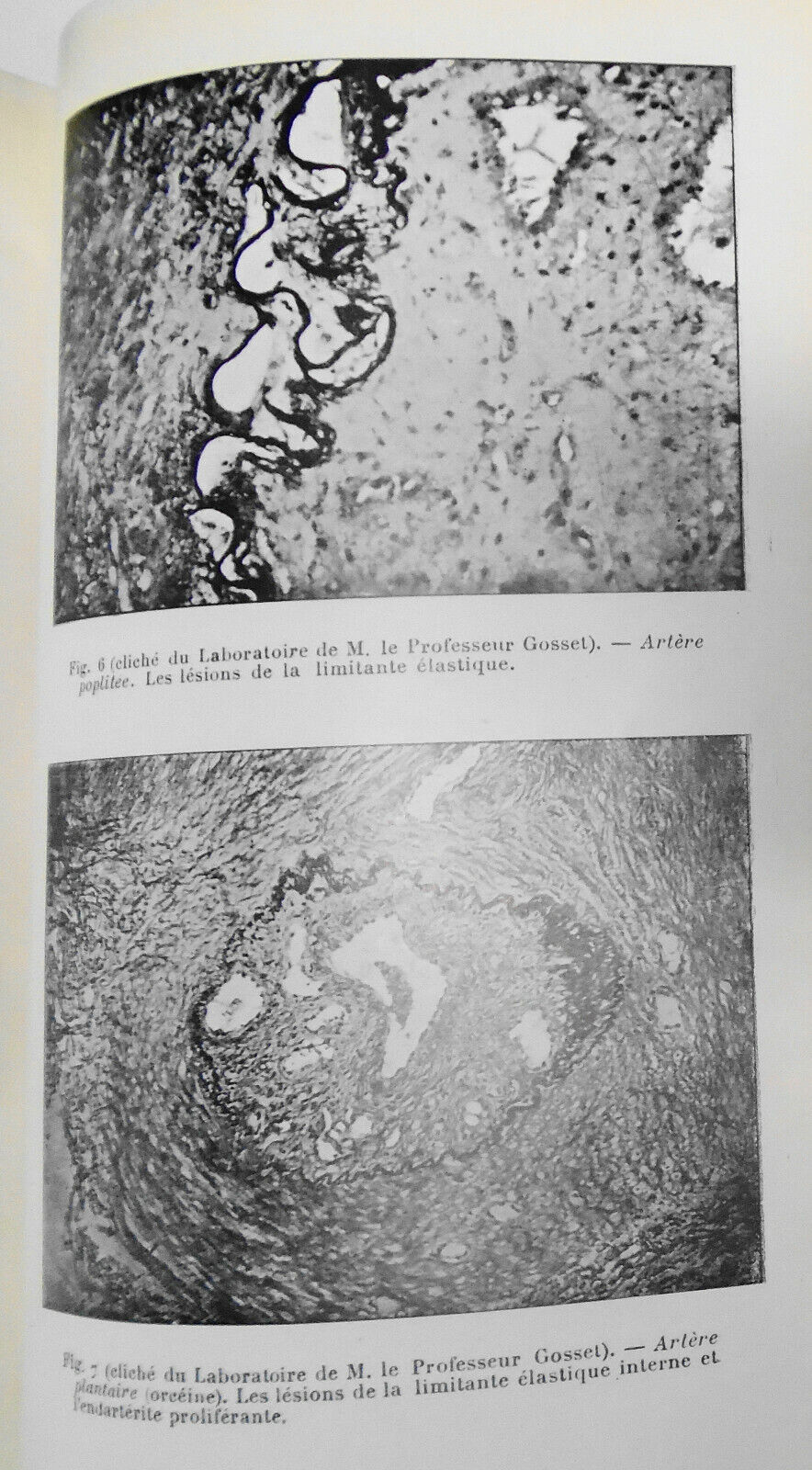 1928 - Etude Chirurgicale Des Gangrenes Juveniles ... by Raymond Leibovici, Dr.