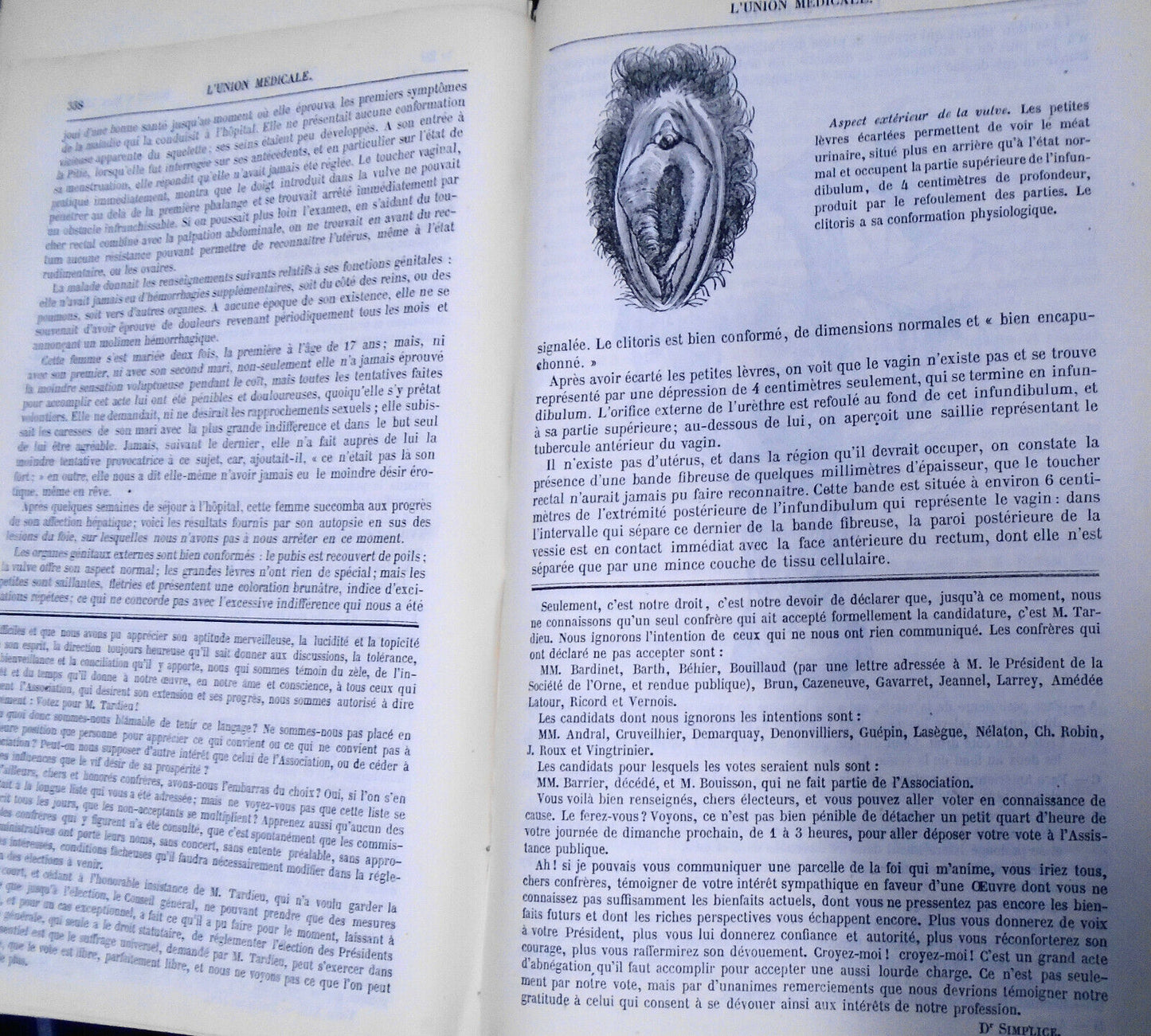 1872 L'union Medicale - Journal Des Interets Scientifique Et Pratiques...Medical