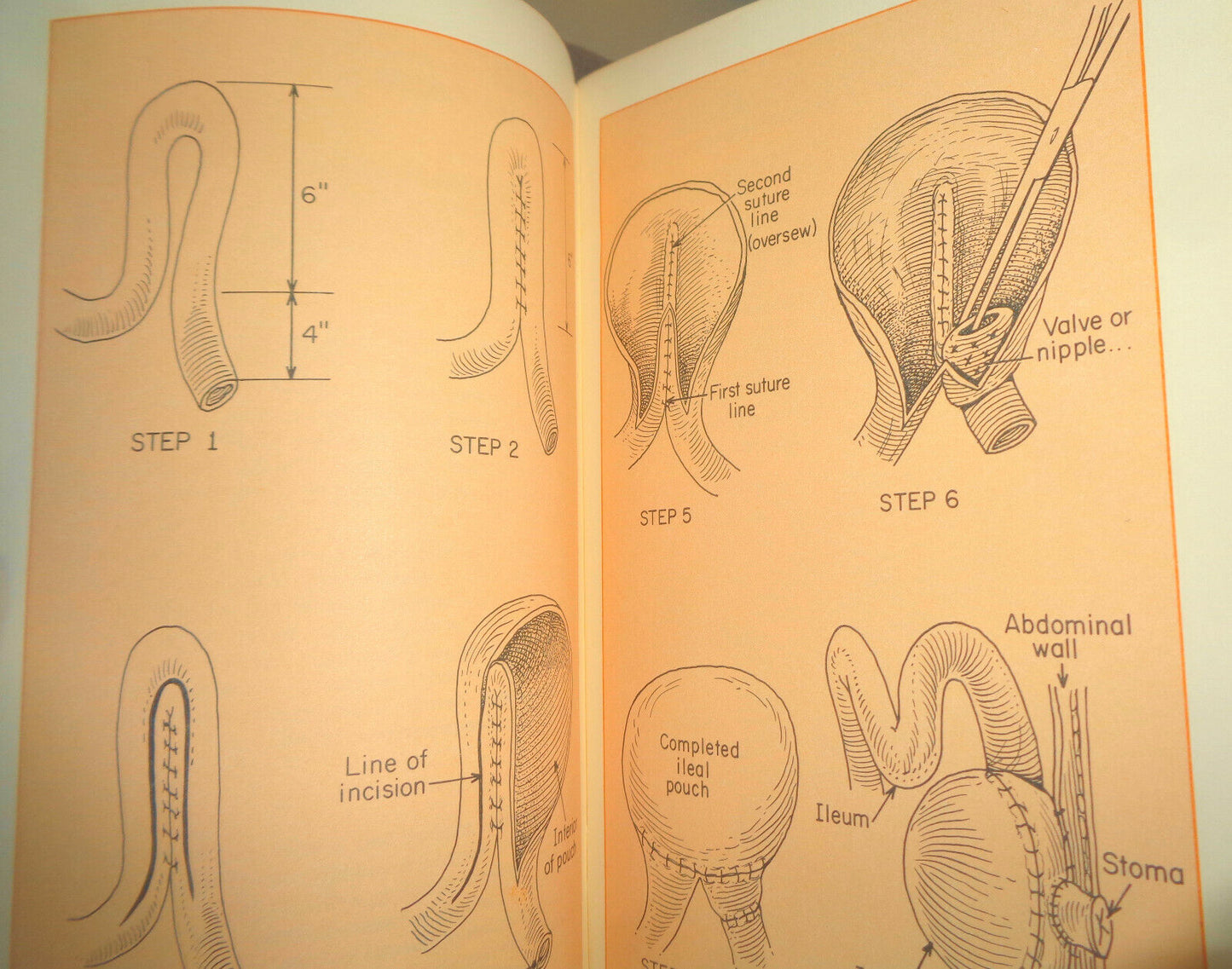 The ileal pouch procedure : a new outlook for the person with an ileostomy 1975